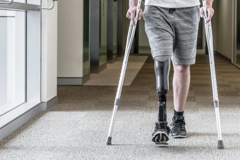 Ampute Rehabilitasyonu